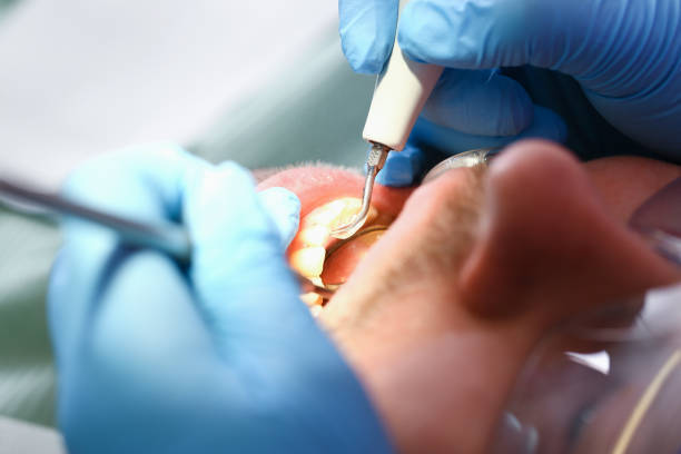 Best Emergency Dental Care for Broken or Chipped Teeth in Independence, VA