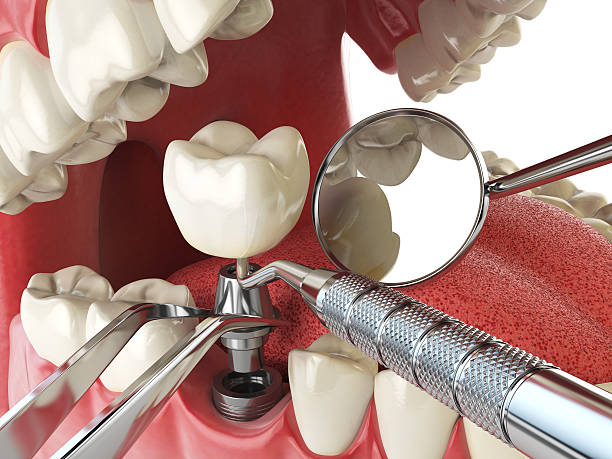 Best Emergency Root Canal Treatment in Independence, VA